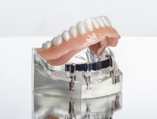 Model smile with all on four dental implant denture