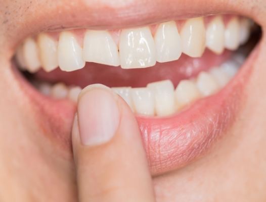 Smile with broken tooth before dental bonding