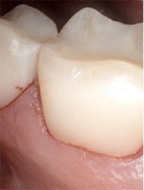 Healthy tooth with new dental restoration
