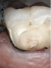 Tooth with severe decay