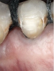 Tooth with black decay before dental restoration