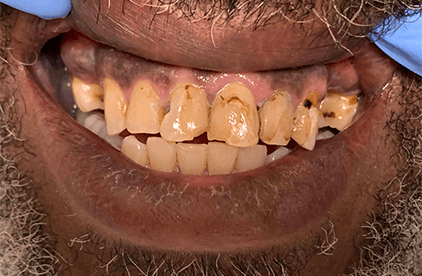 Tooth with black decay before dental restoration