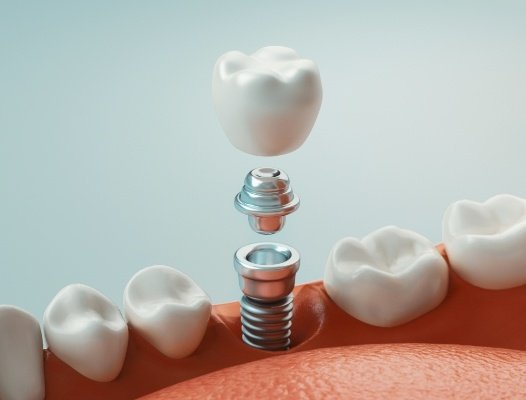 Aniamted smile during the dental implant supported dental crown placement process
