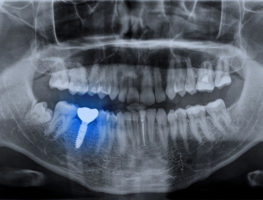 X-ray of smile with dental implant supported replacement tooth