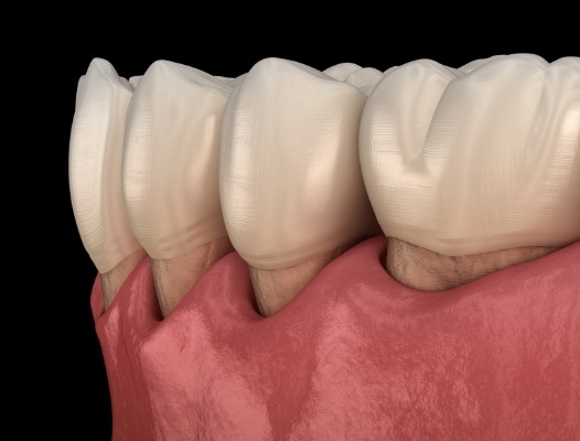 Animated smile with receding gums caused by gum disease
