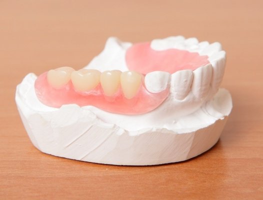Model smile with partial denture restorative dentistry