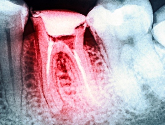 X-ray of smile after root canal therapy