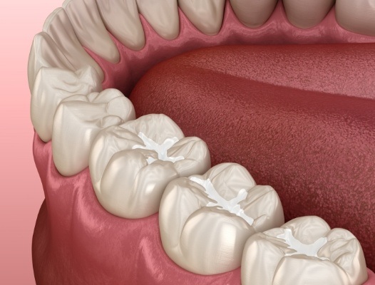 Animated smile with row of tooth colored fillings