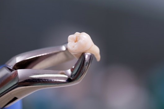 an extracted tooth
