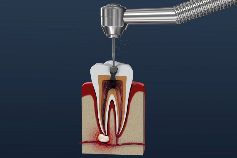 a root canal